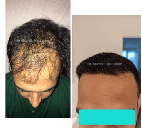 Man with damaged hair before and after using a hair mask at Neo Plant Advance Hair and Skin Clinic.