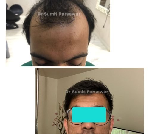 Man with dandruff before and after microneedling at Neo Plant Advance Hair and Skin Clinic.