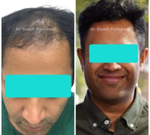 Man with damaged hair before and after mesotherapy at Neo Plant Advance Hair and Skin Clinic.