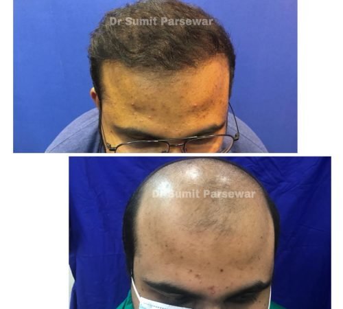 Man with thinning hair before and after PRP therapy at Neo Plant Advance Hair and Skin Clinic.